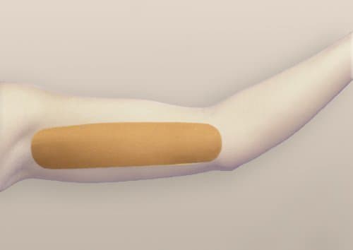 OleevaBrachioplasty Shape (Each) by Oleeva