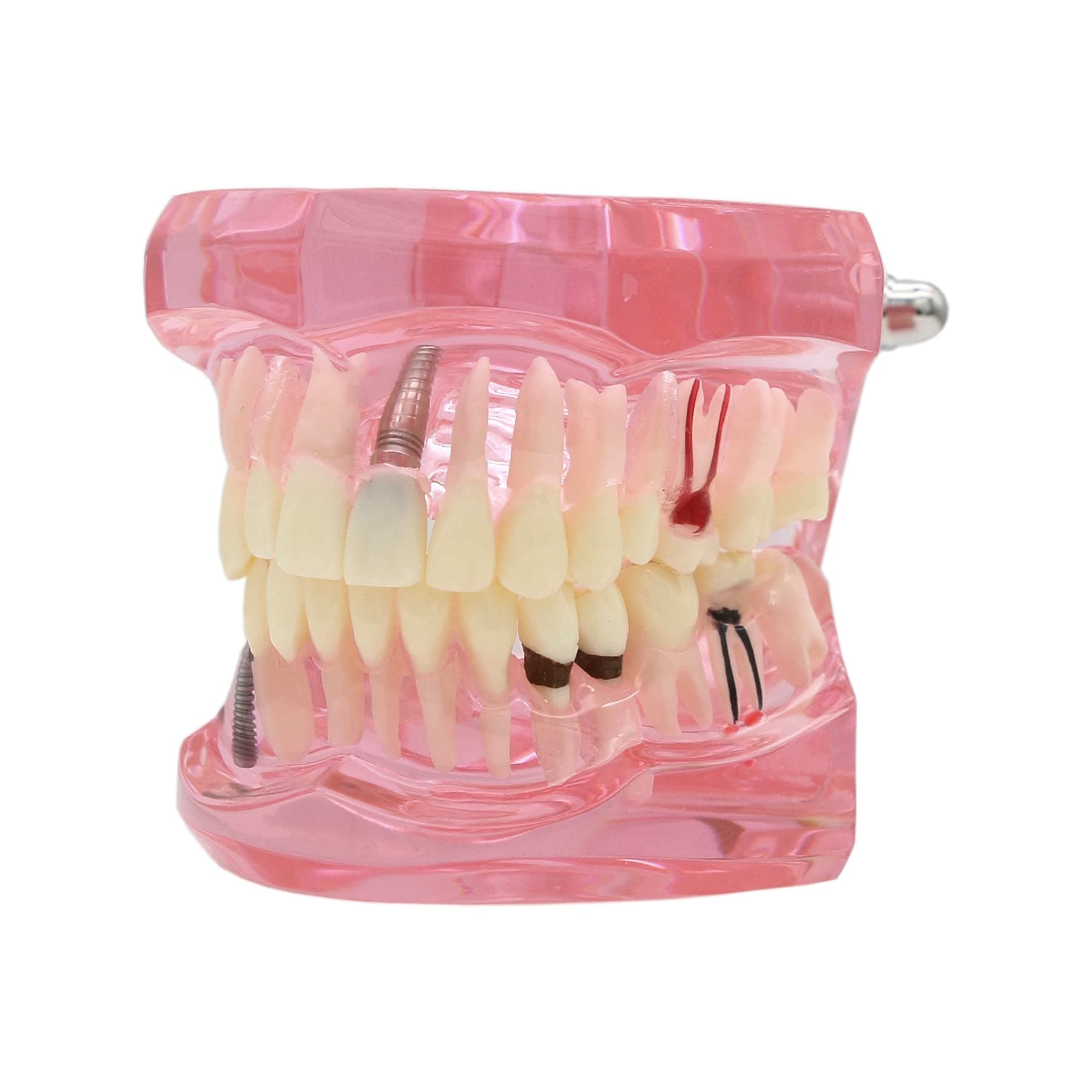 Dentalmall 1 Pc Dental Implant Study Analysis Demonstration Teeth Model #2001 with Restoration Pink