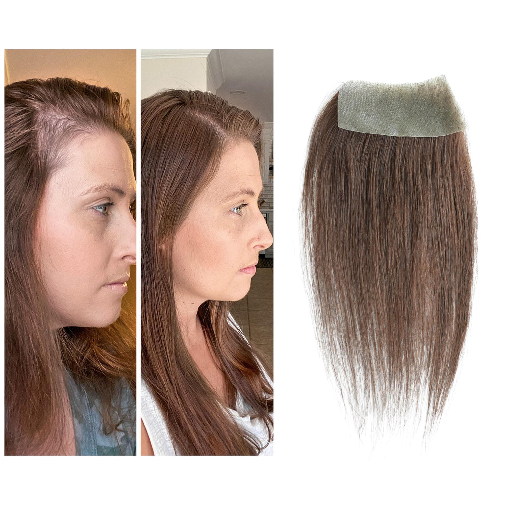 scar human hair replacement Accidental burns without hair for men women Hairline Loss Straight Tape in Replacement Toupee (Medium Brown, 1.57"x3")