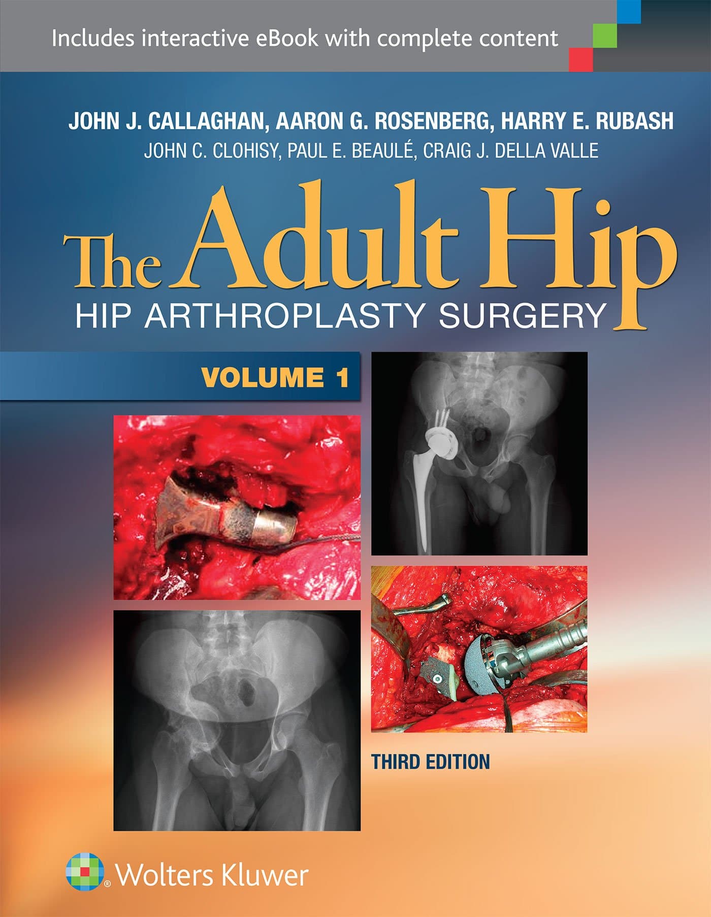 The Adult Hip (Two Volume Set): Hip Arthroplasty Surgery Third Edition