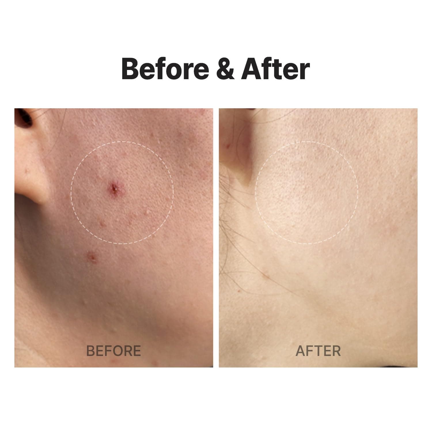 MEDITHERAPY A Clearing Toner Swab (1.57in Swabs + 0.33 fl.oz Toner), Pore Tightening Swab (7 Pouches), Soft Exfoliator for Acne-Prone Skin, Vegan, Korean Skincare